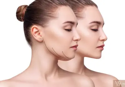 Does Kybella Work For Everyone?