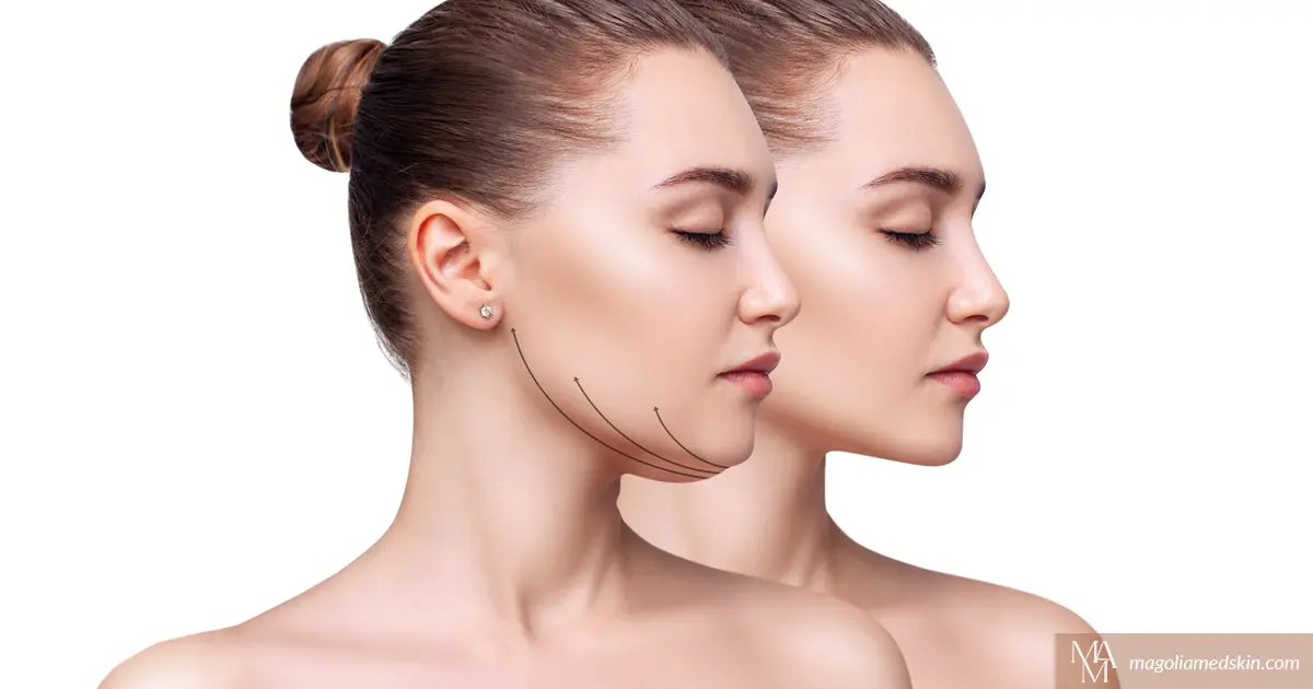 Does Kybella Work For Everyone?